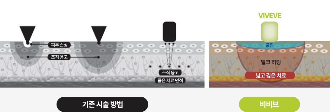 기존 시술 방법, 비비브